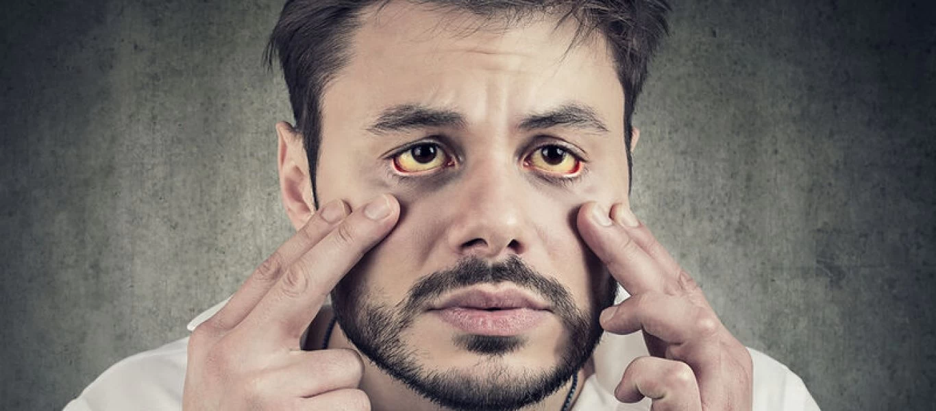 10 πιθανές αιτίες που κάνουν τα μάτια μας κίτρινα